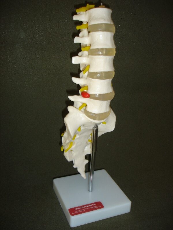 Lumbar Spine - Dr Alistair Bromhead Ltd